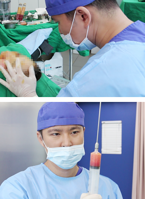 facial fat graft