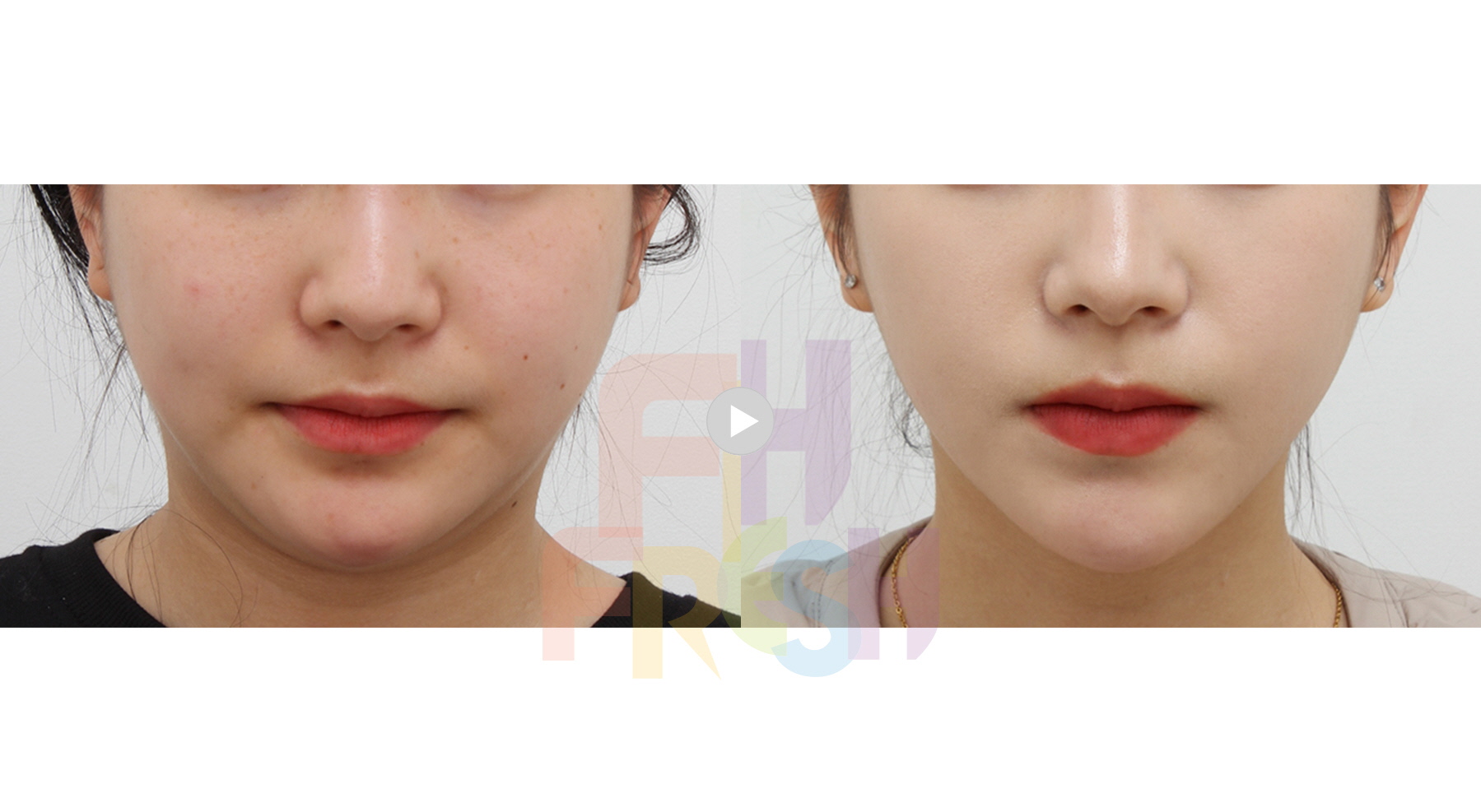 Face Surgery]Accu-zet V Contouring facial liposuction_cheek