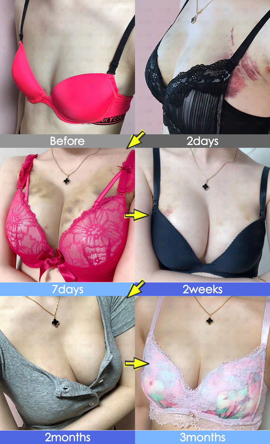 gabapentin before breast augmentation