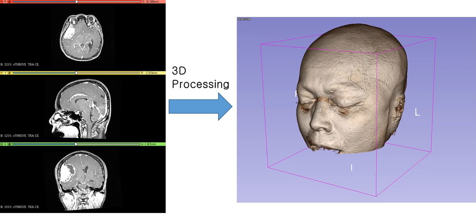 머신러닝과 딥러닝을 사용하는 AI알고리즘을 통해 환자의 DICOM 파일을 자동으로 3D로 변환한다. 예로, 촬영과 동시에 암 조직을 구분할 수 있는 3D 이미지로 변환된다.