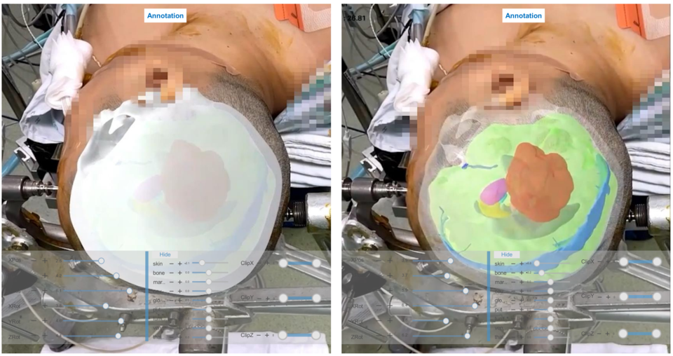 실제 MEDIP PRO AR을 활용해 증강현실로 구현된 환자의 수술 부위