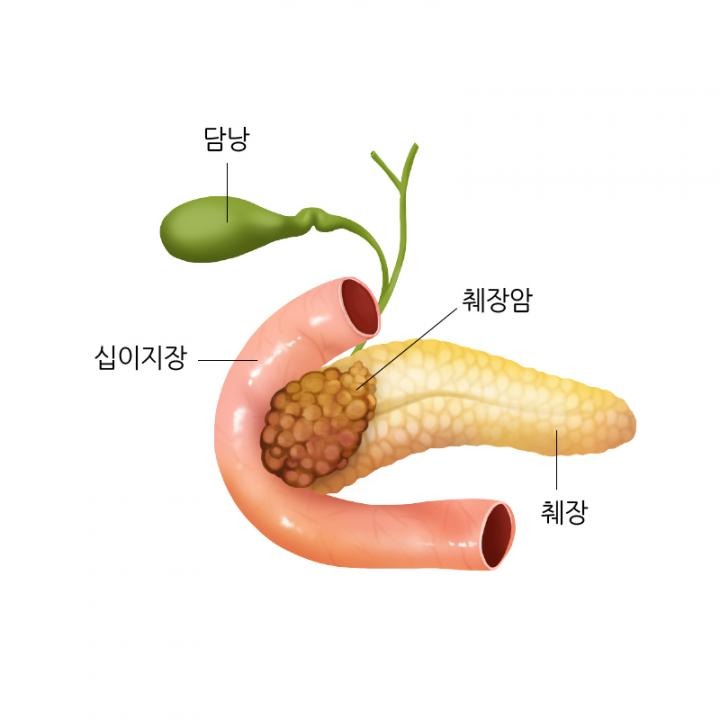 췌장암 생활습관 개선·정기검진으로 예방할 수 있다. : HEAR•TI 하티