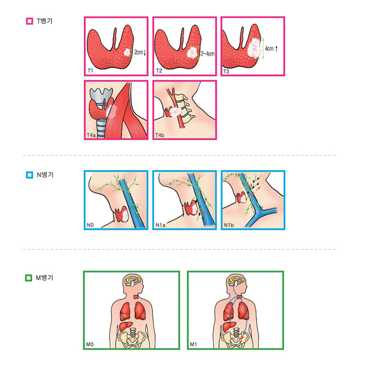 개의 림프절 전체가 부은 것은 암을 의미합니까