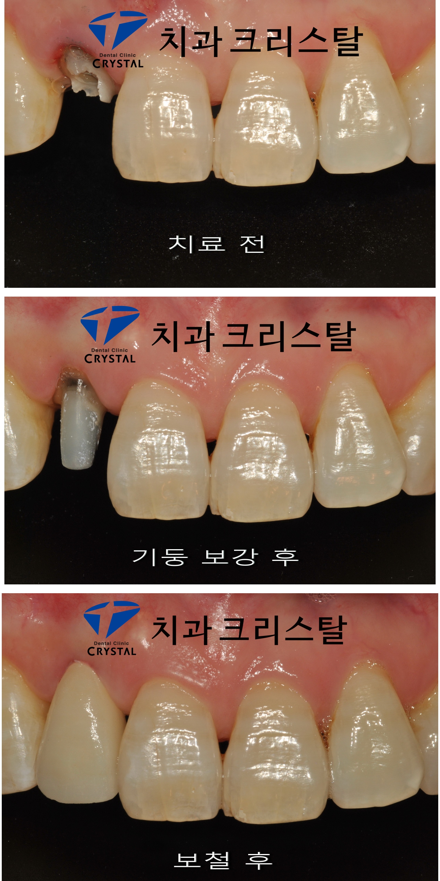 제주신경치료 신경치료 후 크라운 과정을 거치지 않는다면?