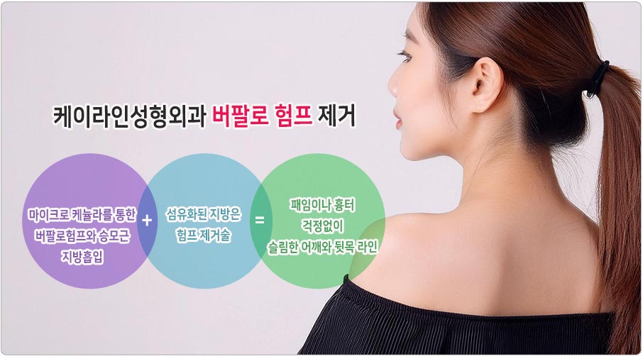 버팔로 험프 지방흡입