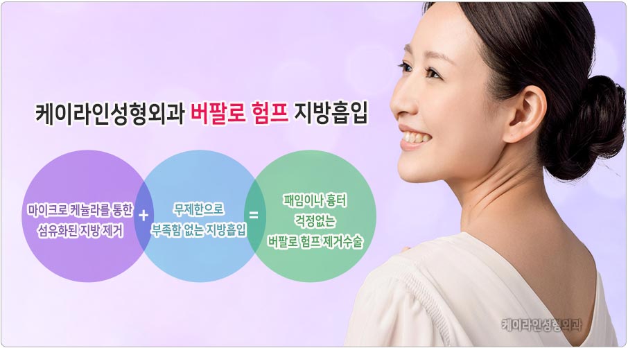 버팔로 험프 지방흡입