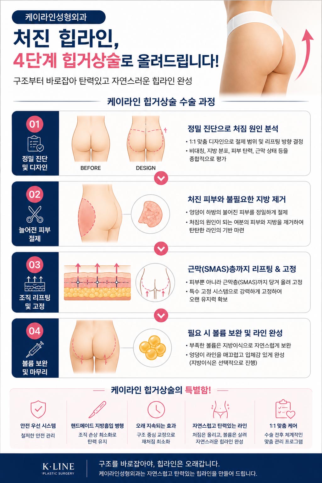 힙거상 방법