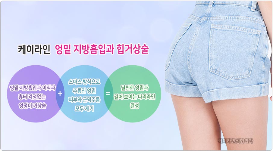 엉밑 성형