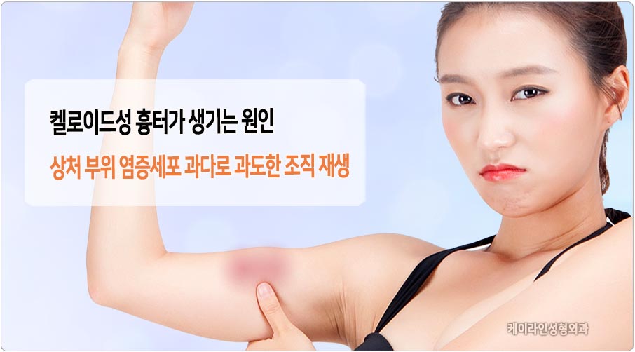 켈로이드 흉터 원인