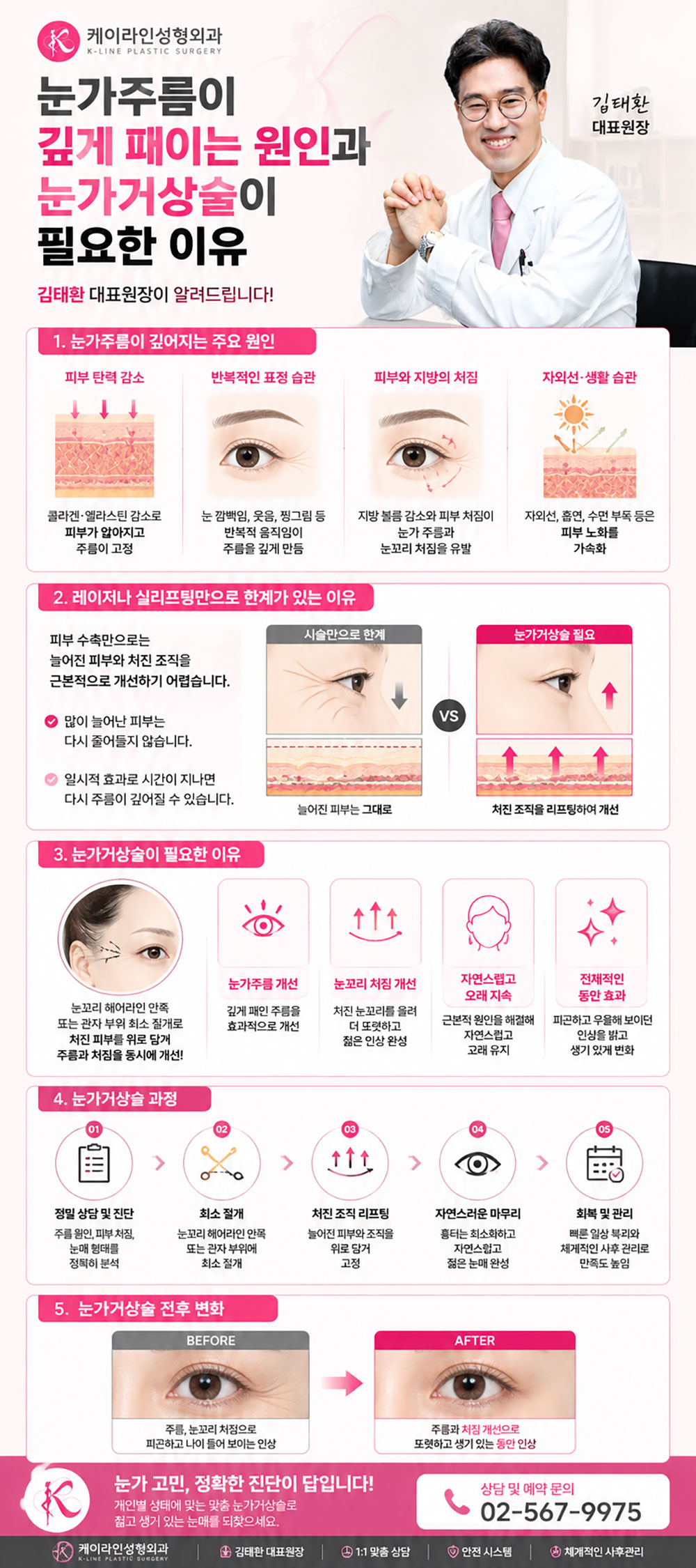 눈가 거상술 방법