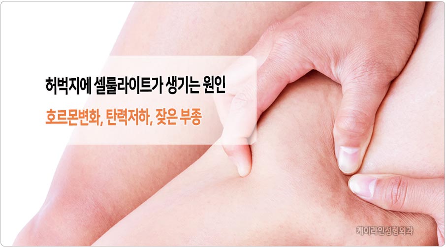 셀룰라이트가 생기는 원인