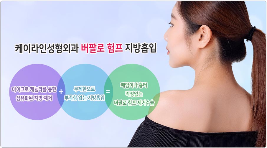 버팔로 험프 지방흡입
