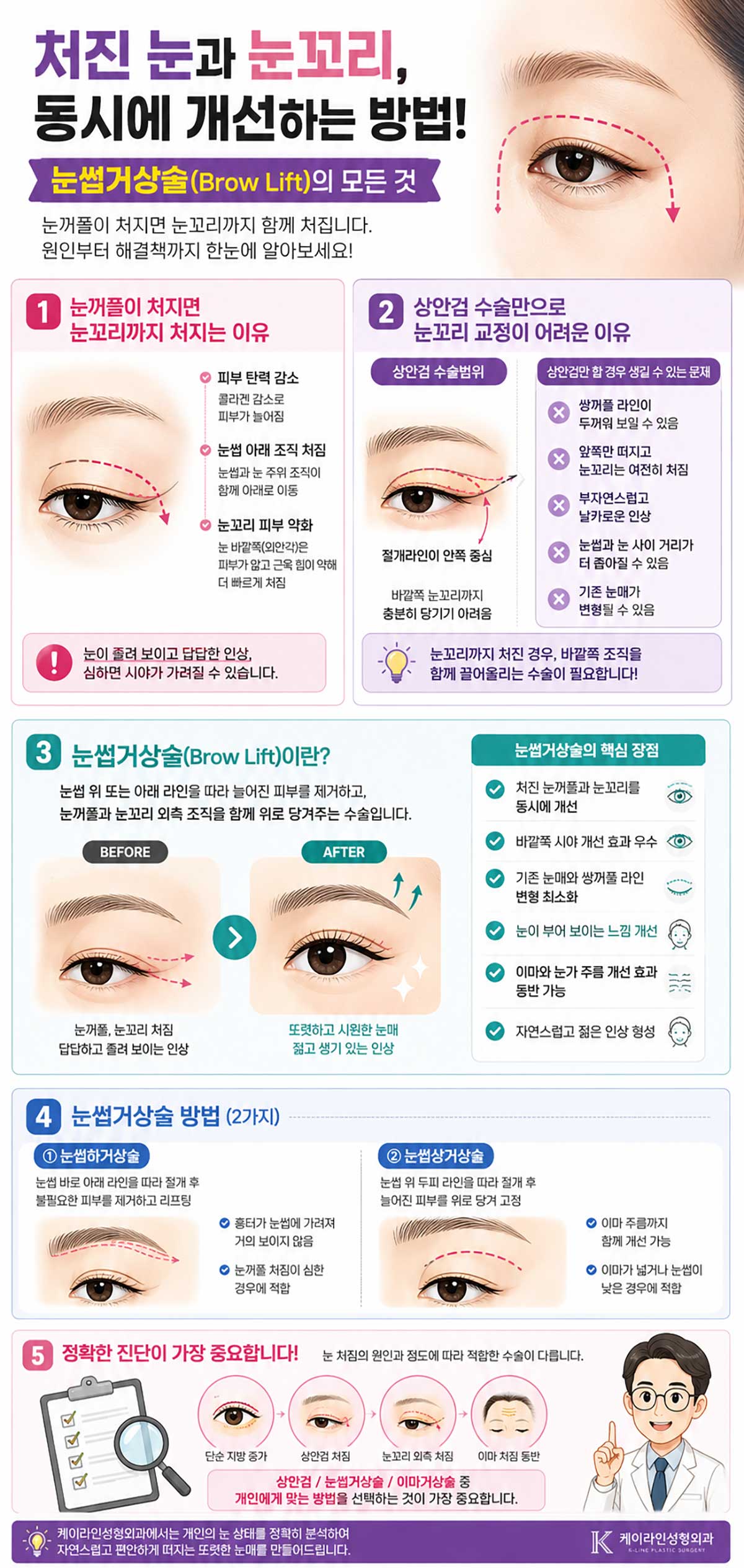 눈썹거상술 방법