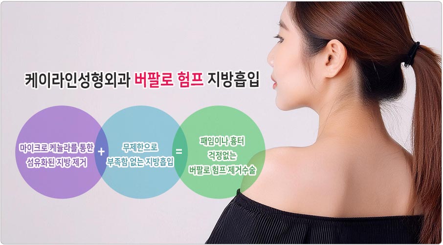버팔로험프 지방흡입