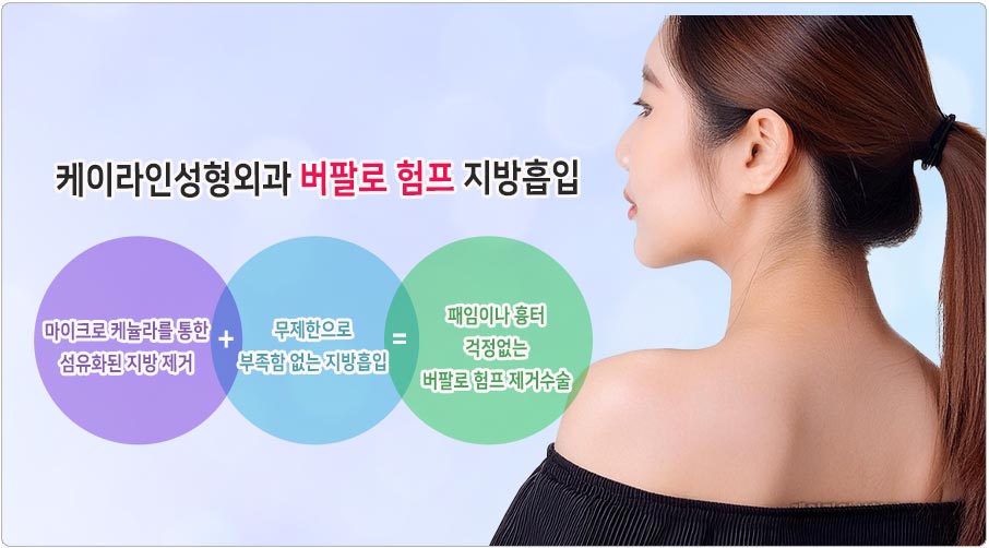 버팔로 험프 지방흡입