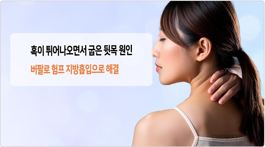굽은 뒷목 버팔로 험프 지방흡입