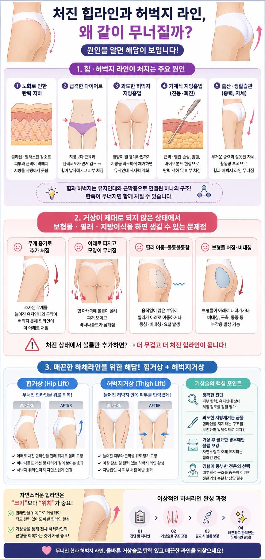 힙과 허벅지 거상술 특징