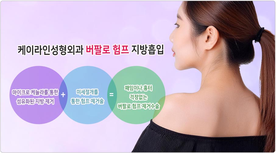 버팔로 험프 지방흡입