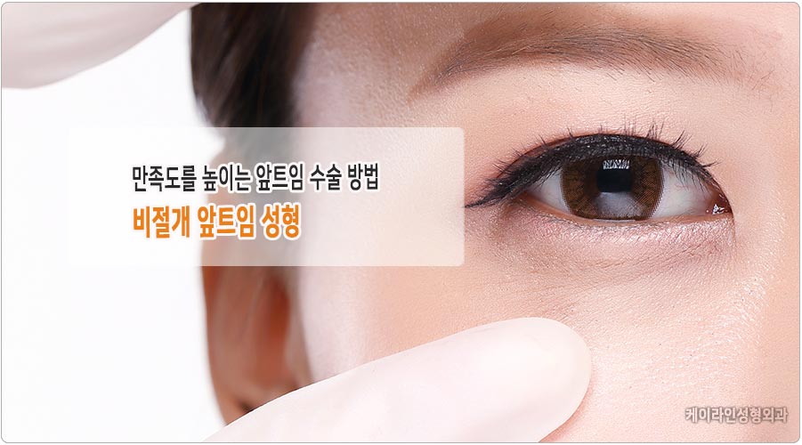 만족도를 높이는 비절개 앞트임 성형