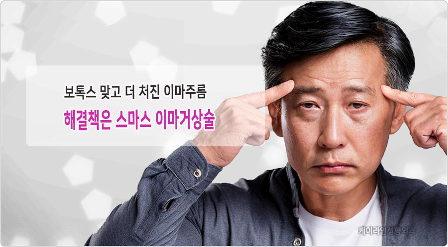 보톡스로 인한 이마주름은 스마스 이마거상술 필요