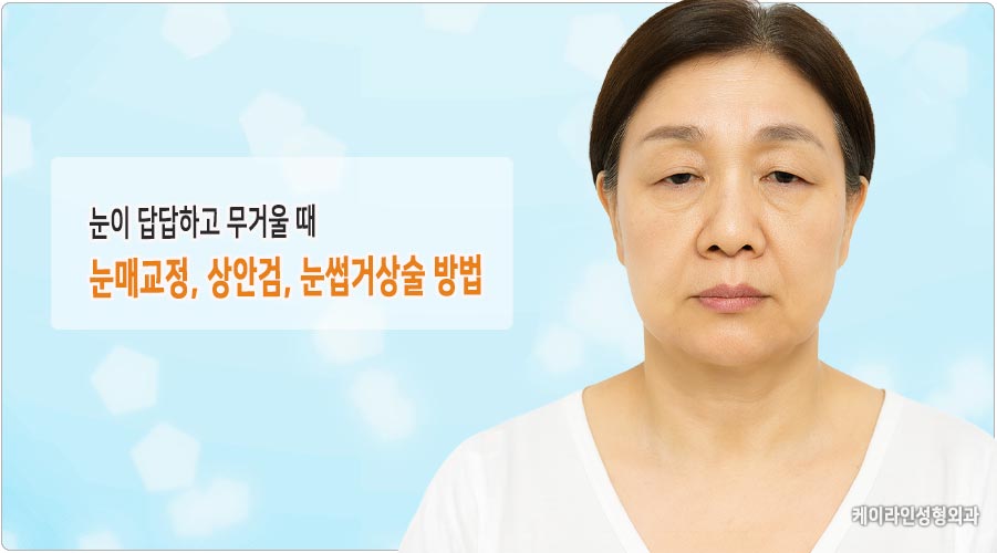 답답한 눈 눈매교정과 상안검 눈썹거상술