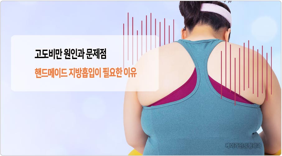 고도비만 지방흡입 필요성