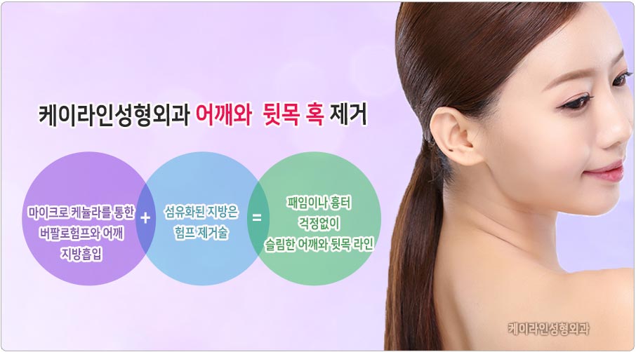 버팔로 험프 지방흡입