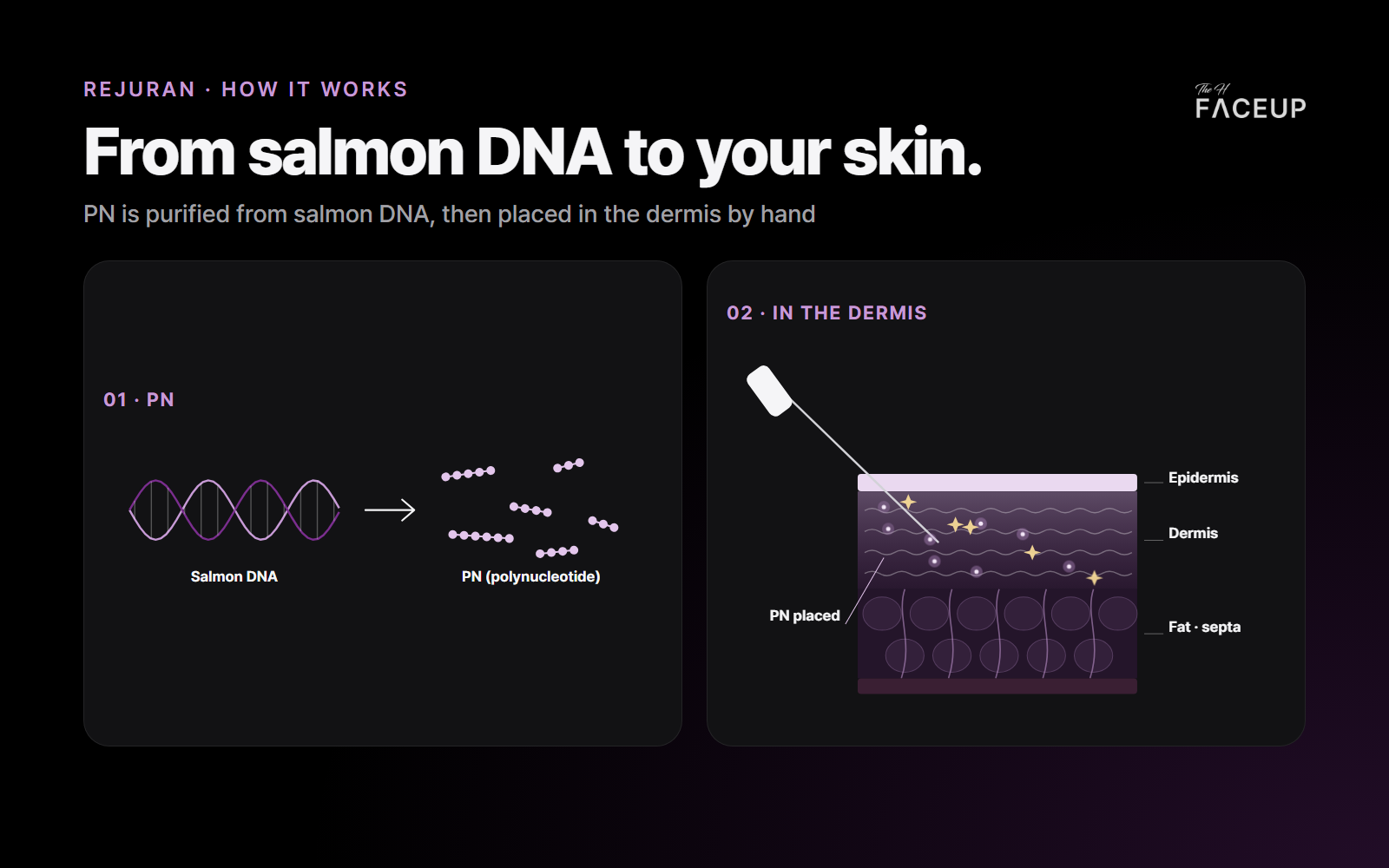 How Rejuran works – PN from salmon DNA placed in the dermis
