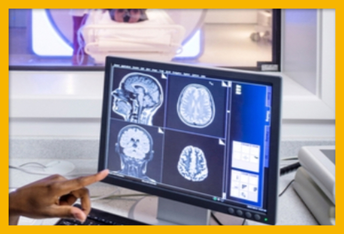 사전에 방비하는 급성 뇌경색 증상과 예방방법 5