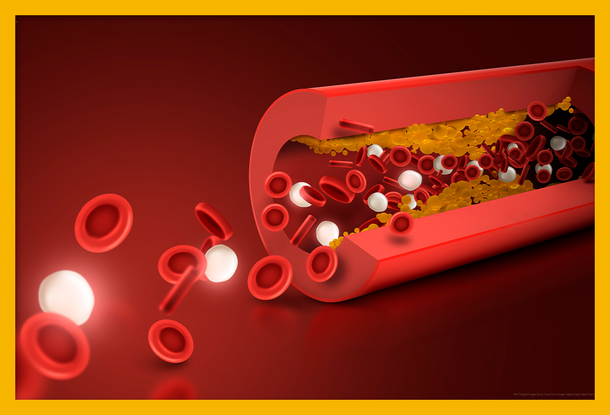 사전에 방비하는 급성 뇌경색 증상과 예방방법 6