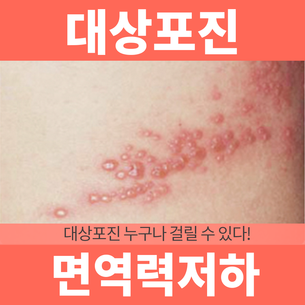 무더위 여름철 면역력이 떨어지면 '대상포진' 조심하세요! : 건강검진정보