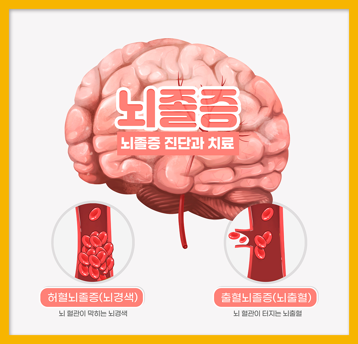 뇌경색과 뇌출혈의 원인은?잠실신경외과