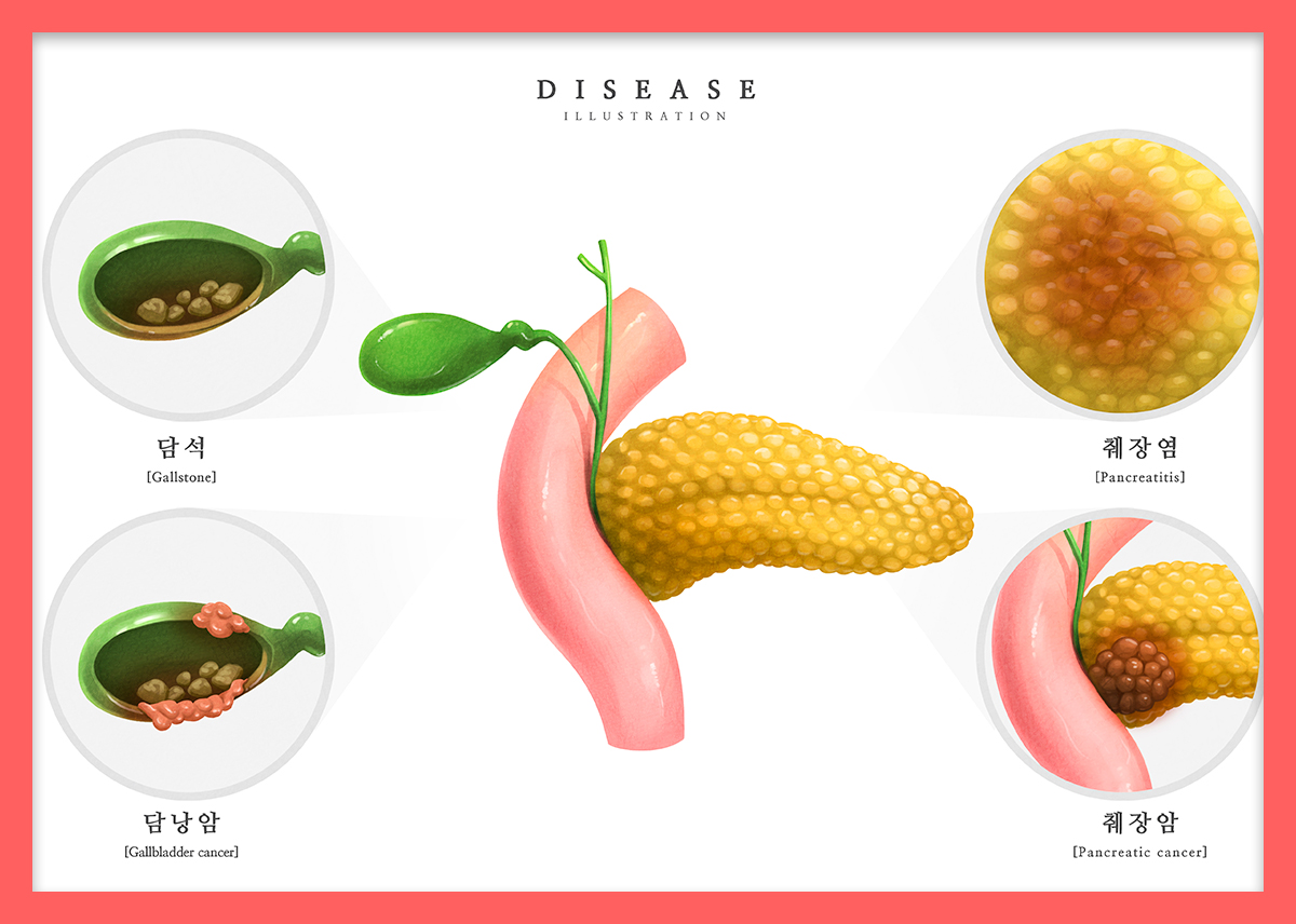 췌장암 증상과 치료 후 관리법 : 건강검진정보