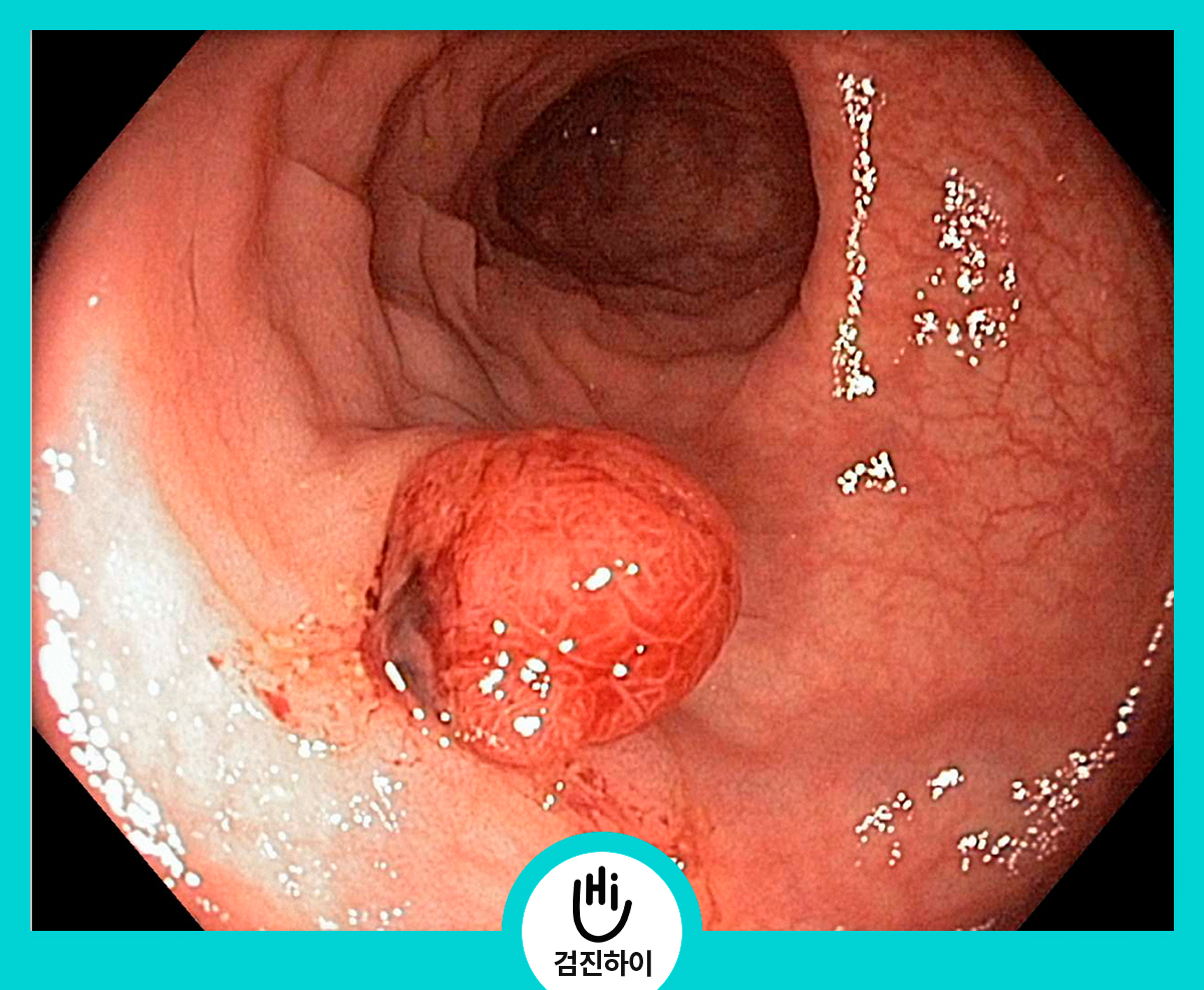 대장내시경검사는 대장암을 유발할 수 있는 대장 용종에 중요합니다