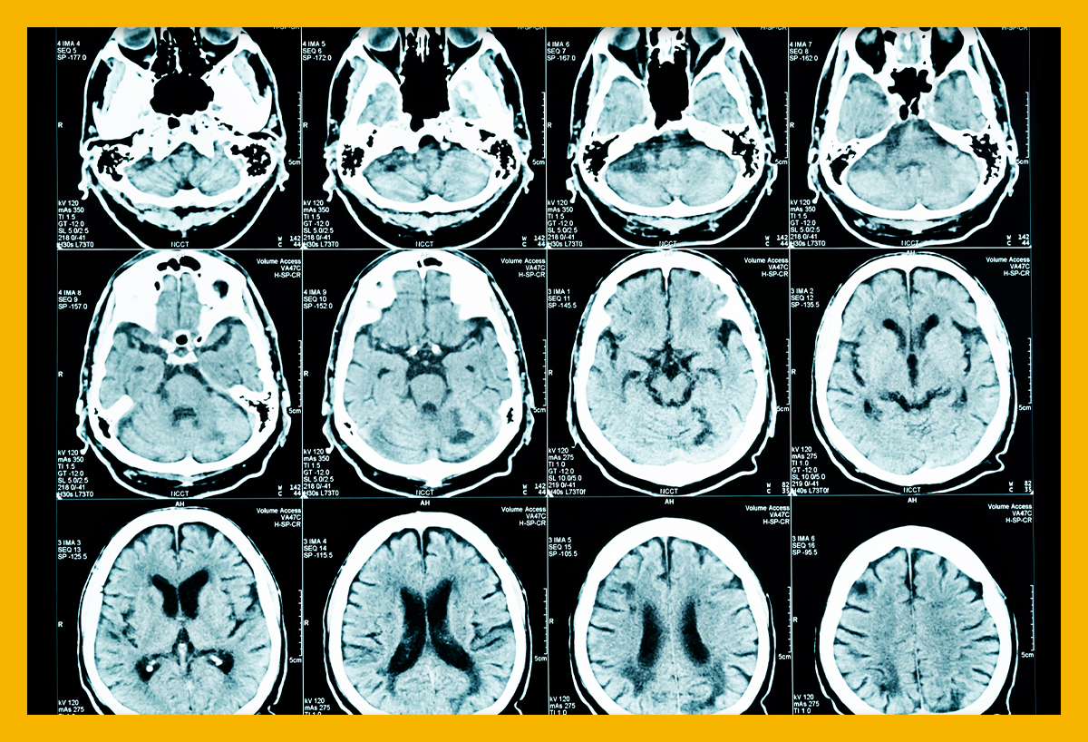 사전에 방비하는 급성 뇌경색 증상과 예방방법 2