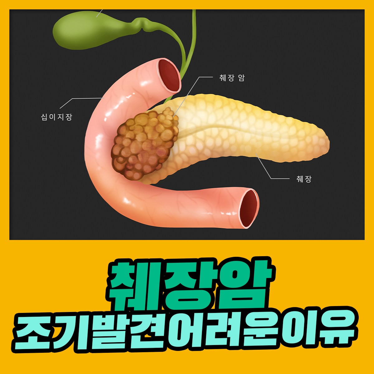 췌장암 , 조기 발견율이 어려운 이유 : 건강검진정보