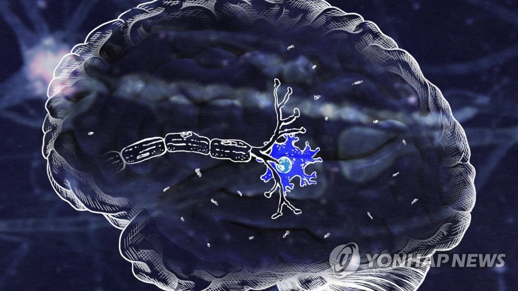 "알츠하이머병 망상·공격성, 뇌 네트워크 재편과 연관 가능성"
