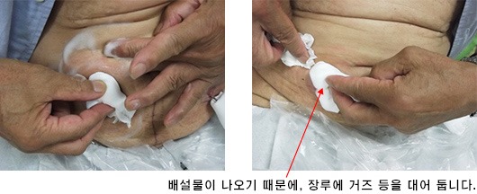 배설물이 나오기 때문에, 장루에 거즈 등을 대어 둡니다.