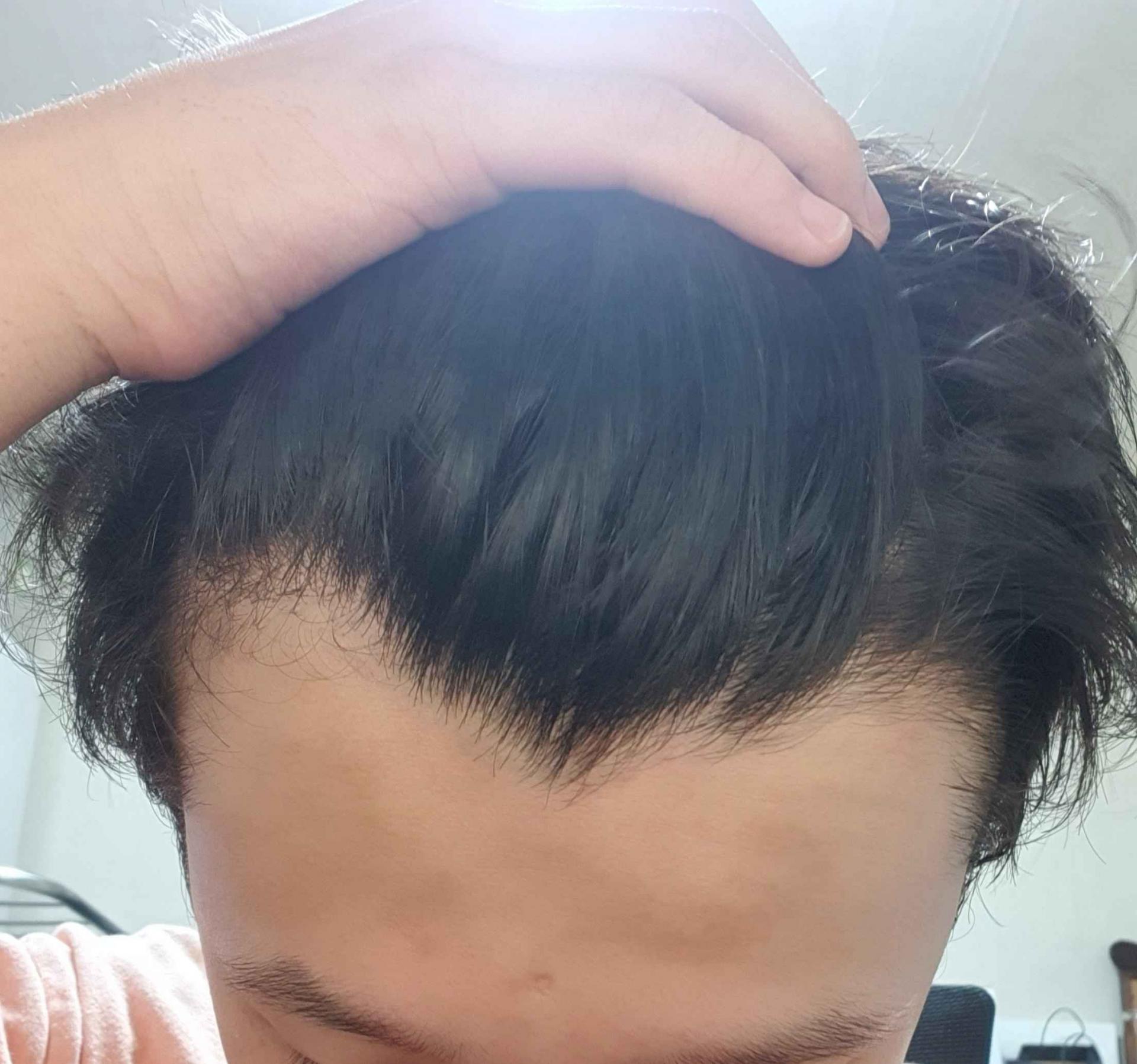  고딩 m 고등학생 m자 탈모인가요? : 탈모온라인상담