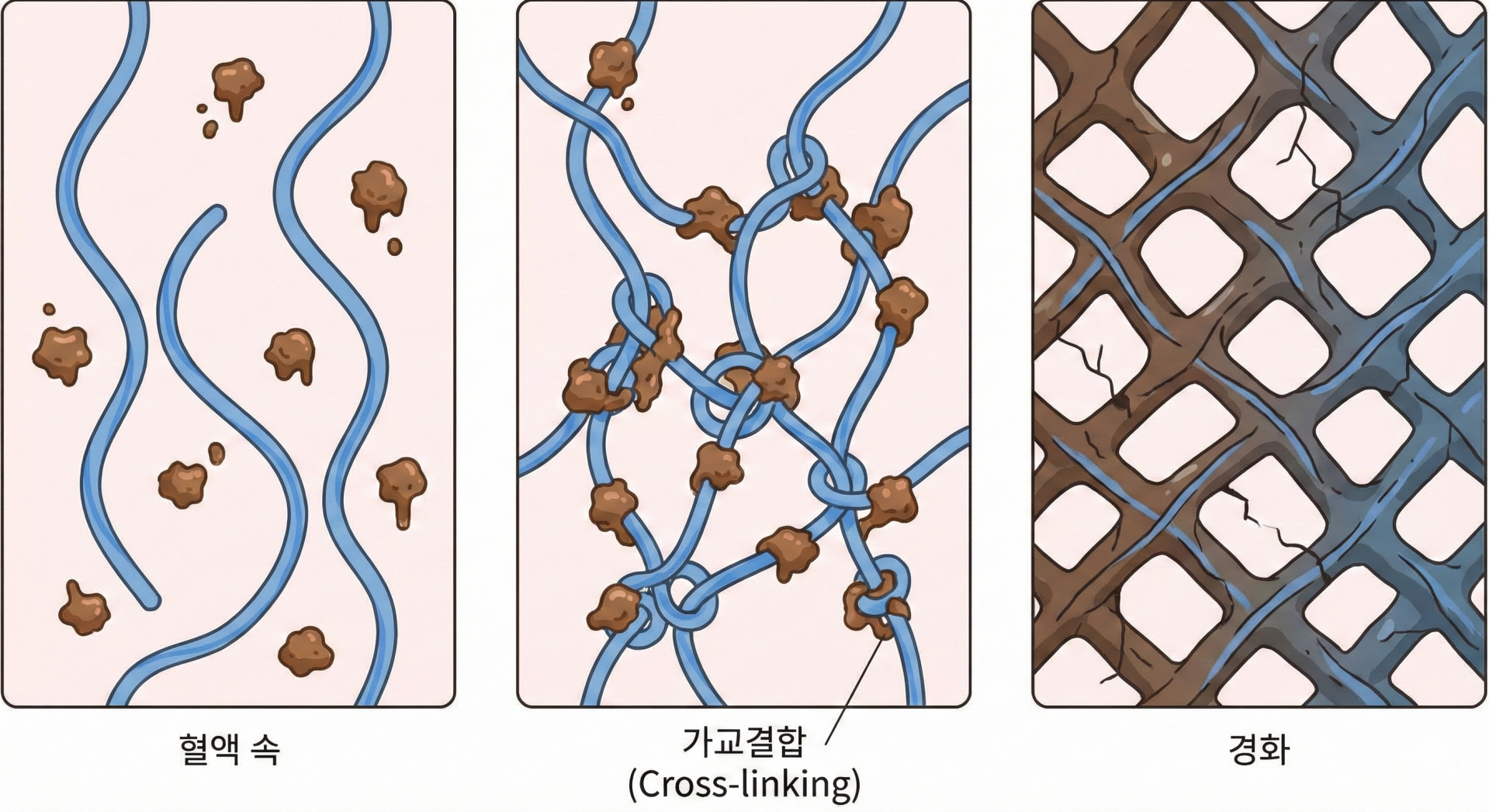 최종당화산물이 콜라겐을 만나 가교결합을 형성하는 모습 @nano banana.png