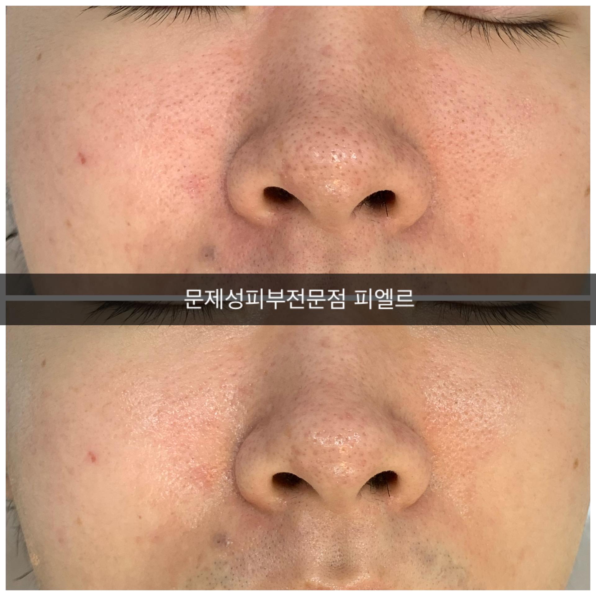 모공 속 피지를 제거하는 포항 아쿠아필로 여드름 퇴치