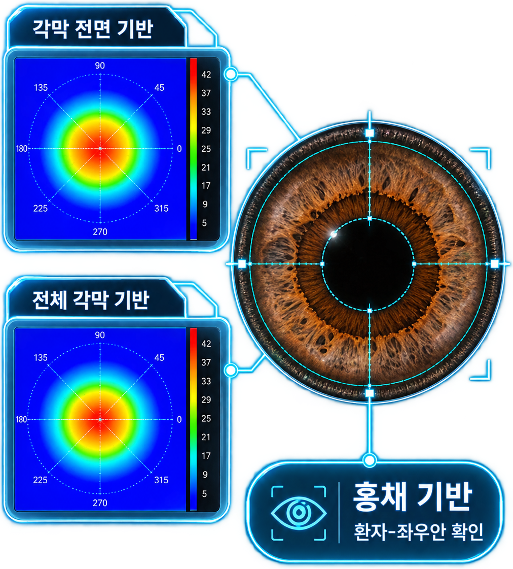 맞춤 전략 선택 - 각막 지형도