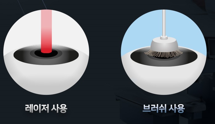 센트럴안과의 라섹 원칙