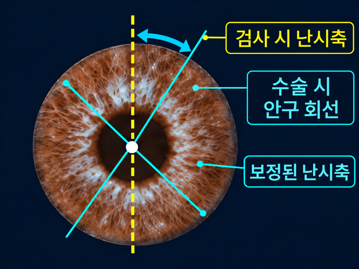안구 회선 보정