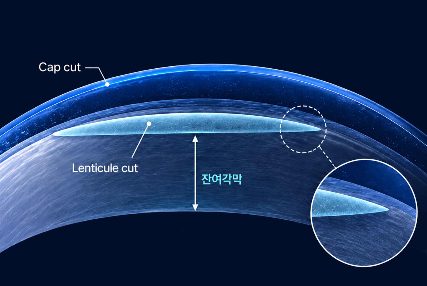 스마트라식 사이드컷 없음 단면도