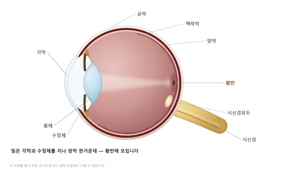 백내장은 눈 앞쪽 수정체, 당뇨망막병증은 눈 뒤쪽 망막의 문제임을 보여주는 모식도