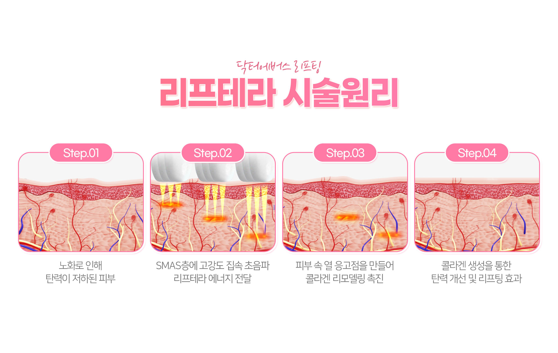 리프테라 원리 마곡피부과 닥터에버스 리프테라 원리 마곡피부과 닥터에버스