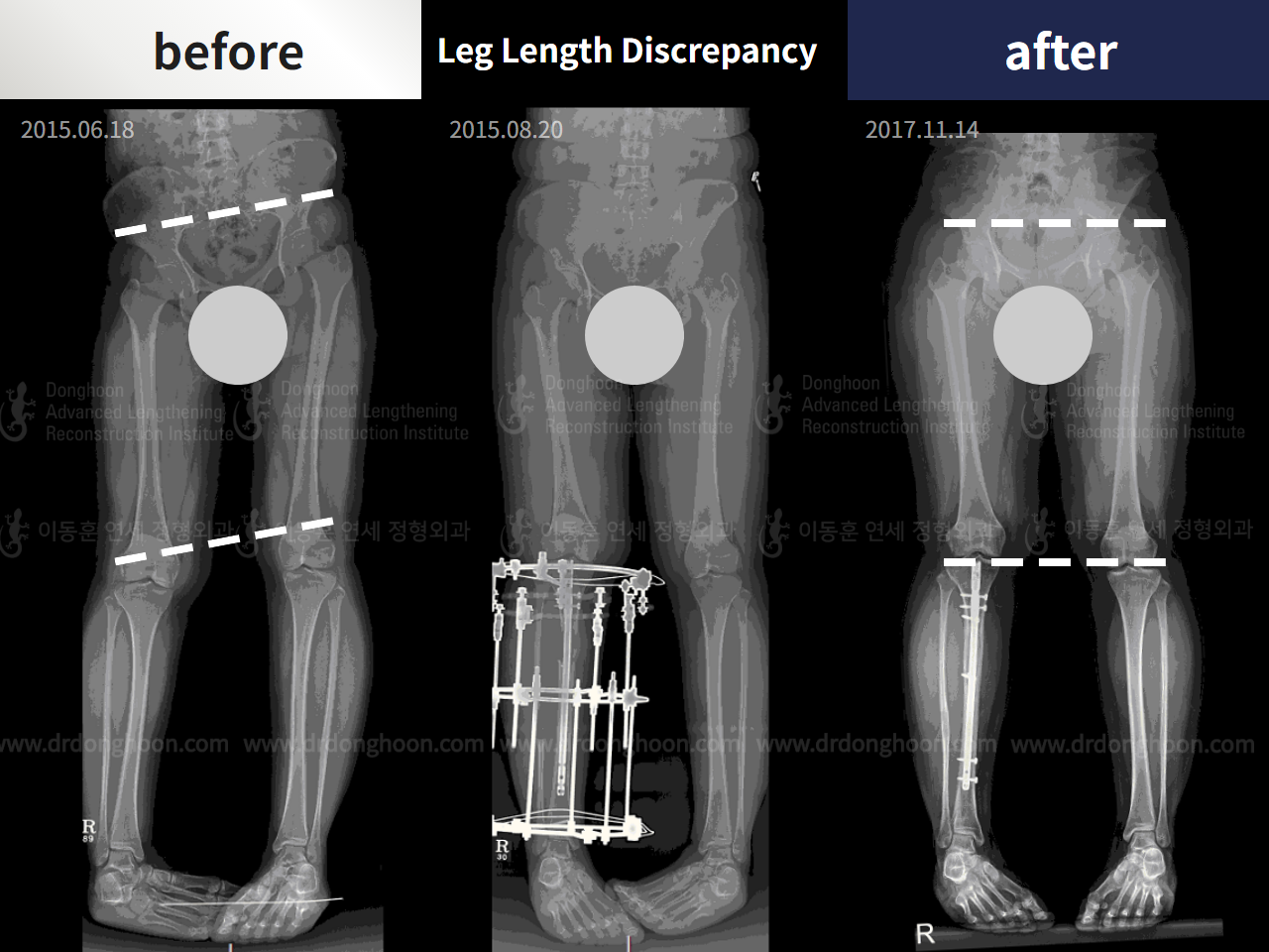 Before and after adult lld, case 4320298, image 3, Dr. Donghoon institute (DALRI)