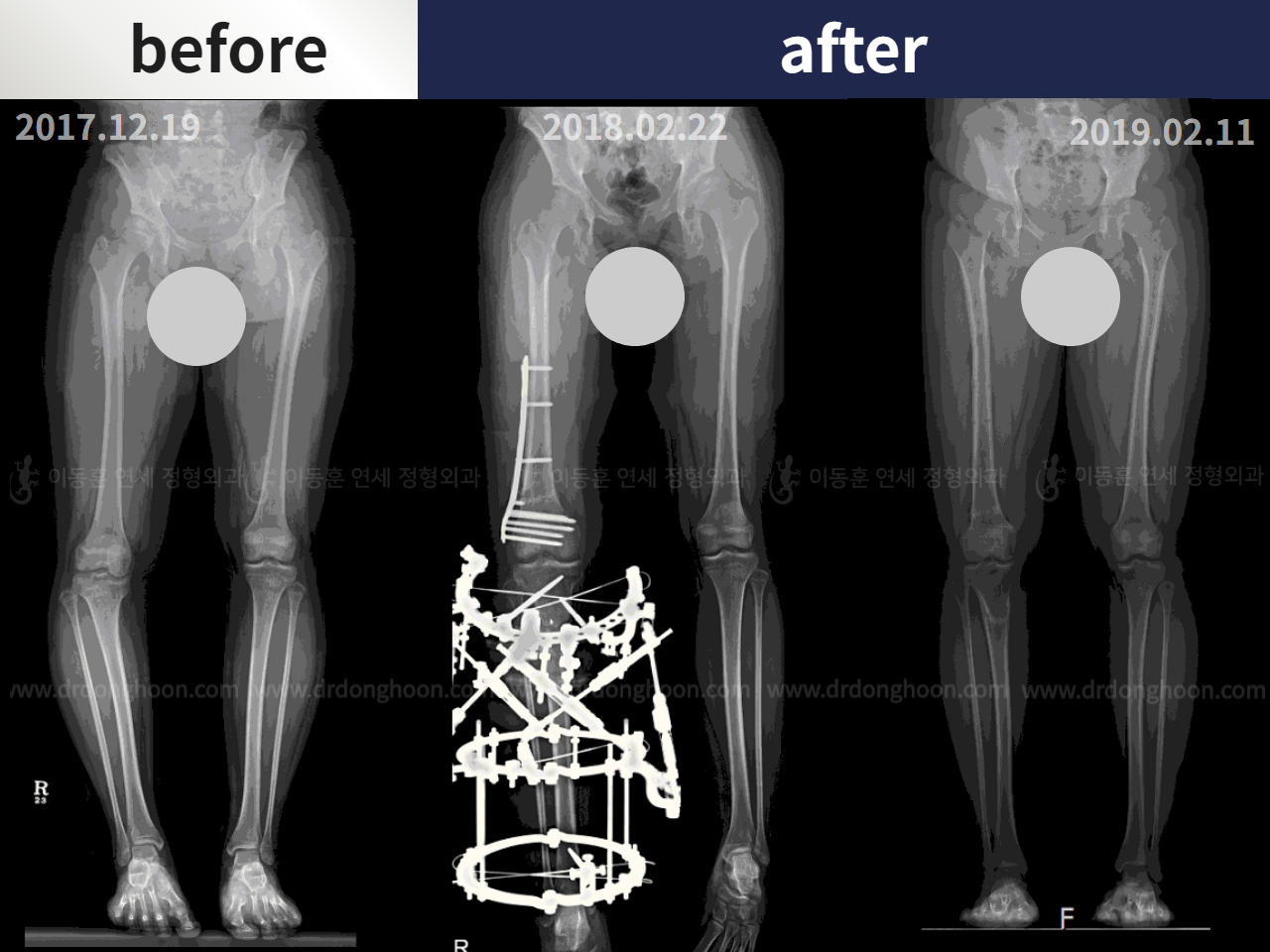 Before and after paediatric & adolescent bowlegs, case 4320272, image 3, Dr. Donghoon institute (DALRI)