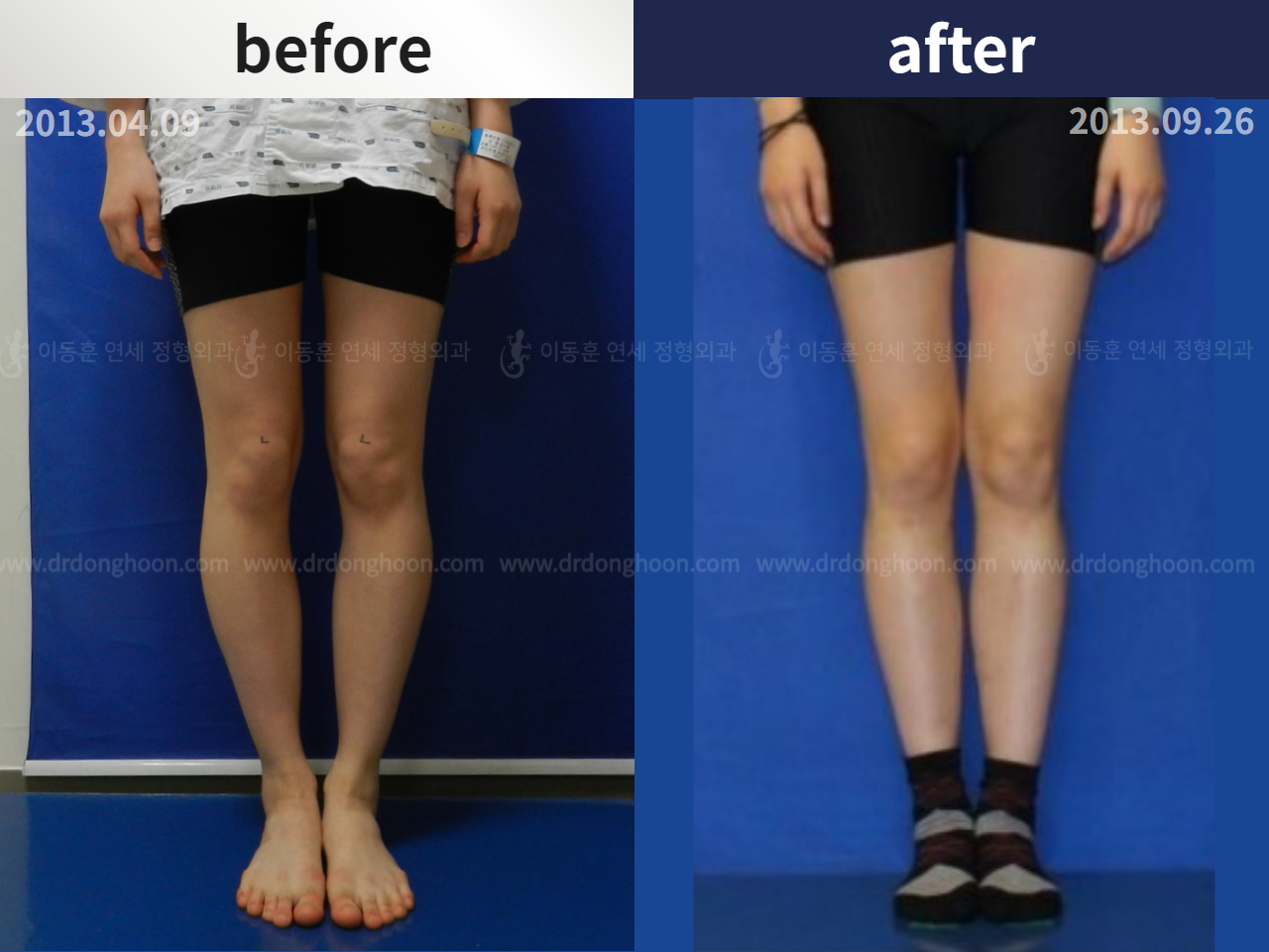 Before and after paediatric & adolescent bowlegs, case 4320240, image 1, Dr. Donghoon institute (DALRI)